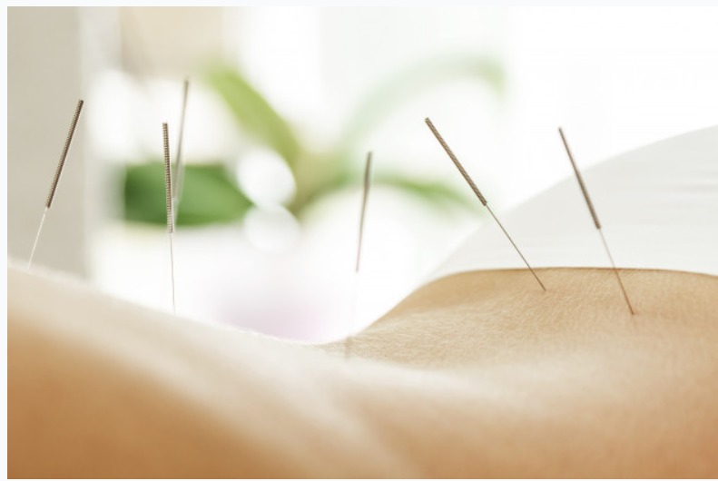 akupunktura